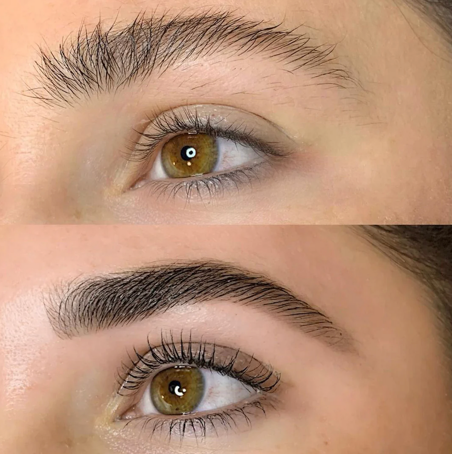 Brow Lift