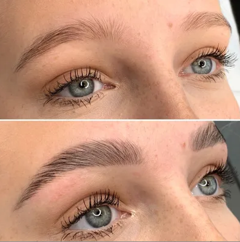 Brow Lift